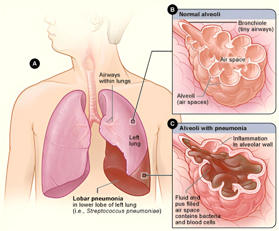 Pneumonia