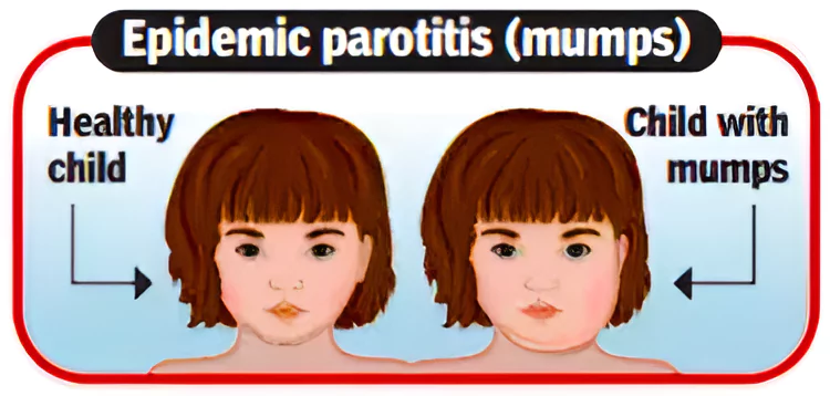 Mumps Outbreak in Kerala
