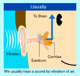 Piezoelectric bone conduction hearing implant