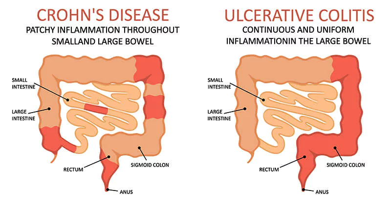 Inflammatory Bowel Disease