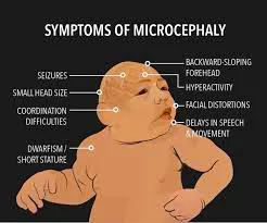 Microcephaly