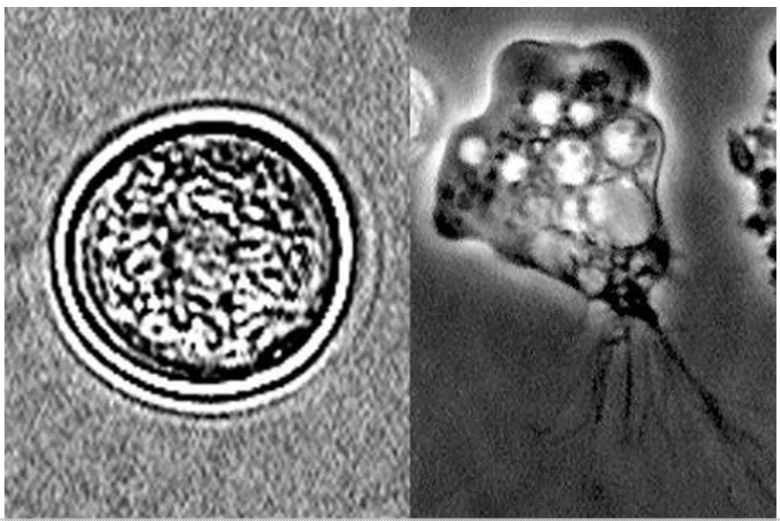 Amoebic Meningoencephalitis