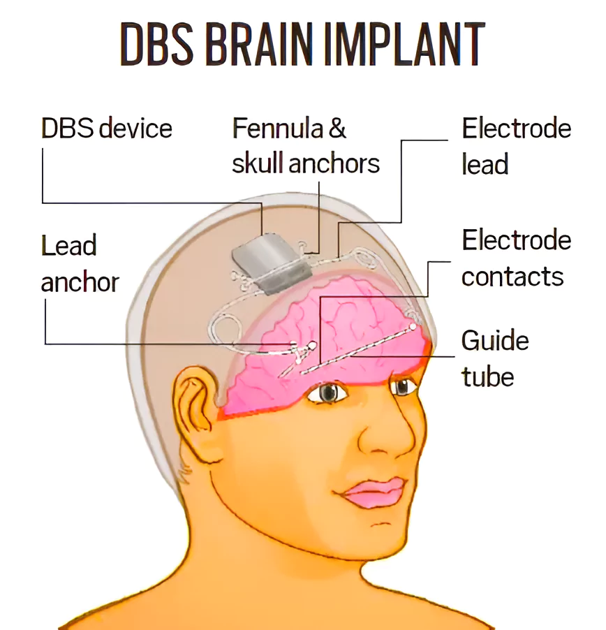 Brain Implant