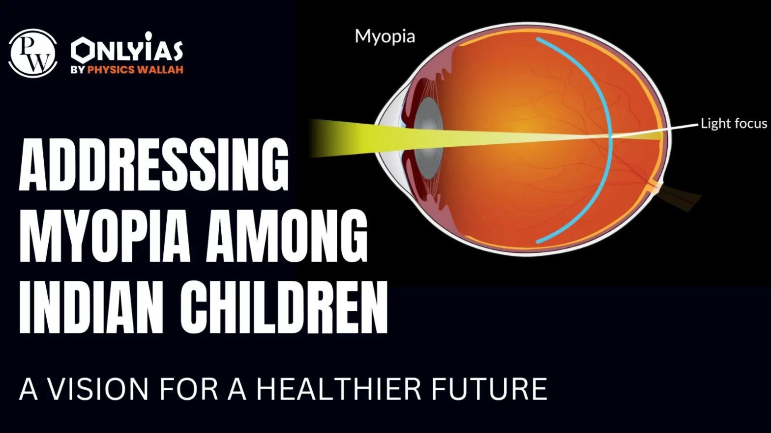 Addressing Myopia Among Indian Children: A Vision for a Healthier Future