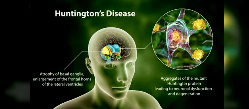 Huntington’s disease