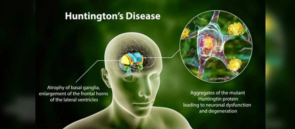 Huntington's Disease