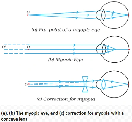 (a), (b) The myopic eye, and (c) correction for myopia with a concave lens