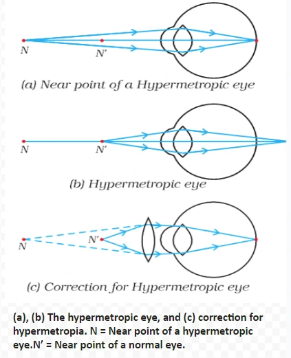 (a), (b) The hypermetropic eye, and (c) correction for hypermetropia. N = Near point of a hypermetropic eye.N’ = Near point of a normal eye.