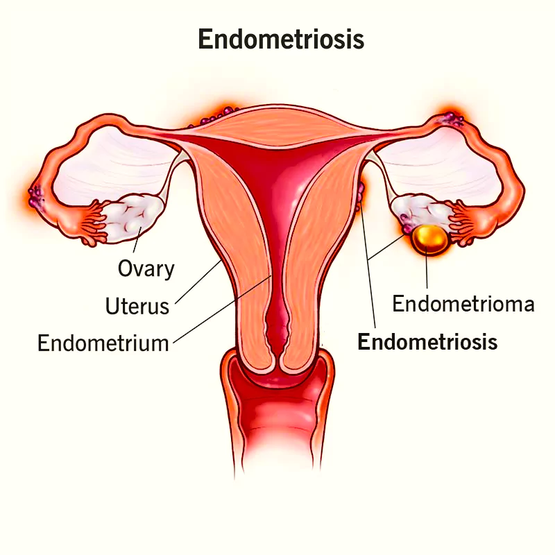 Endometriosis