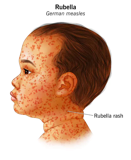 Measles and Rubella Champion Award