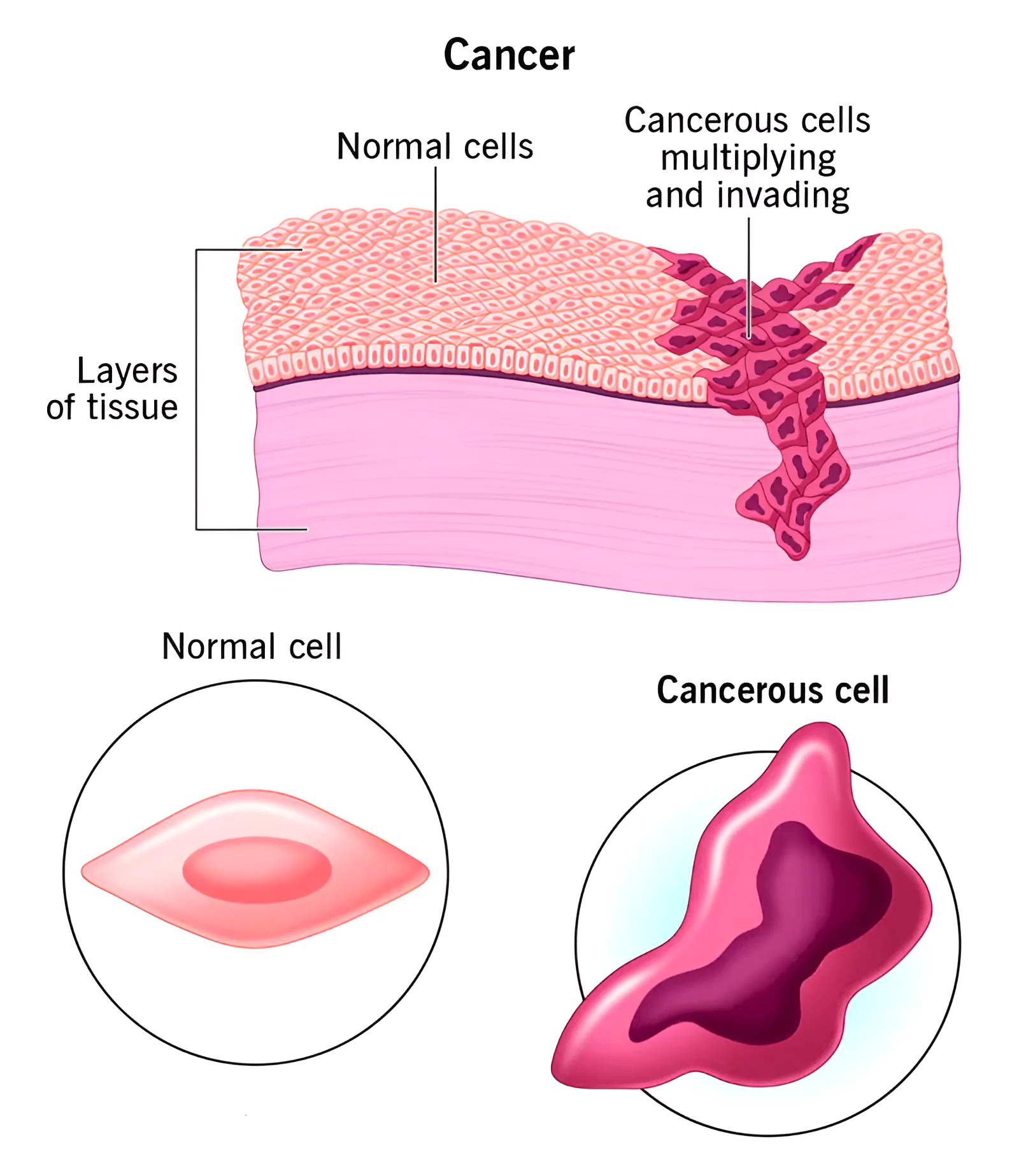 Cancer Cases in India