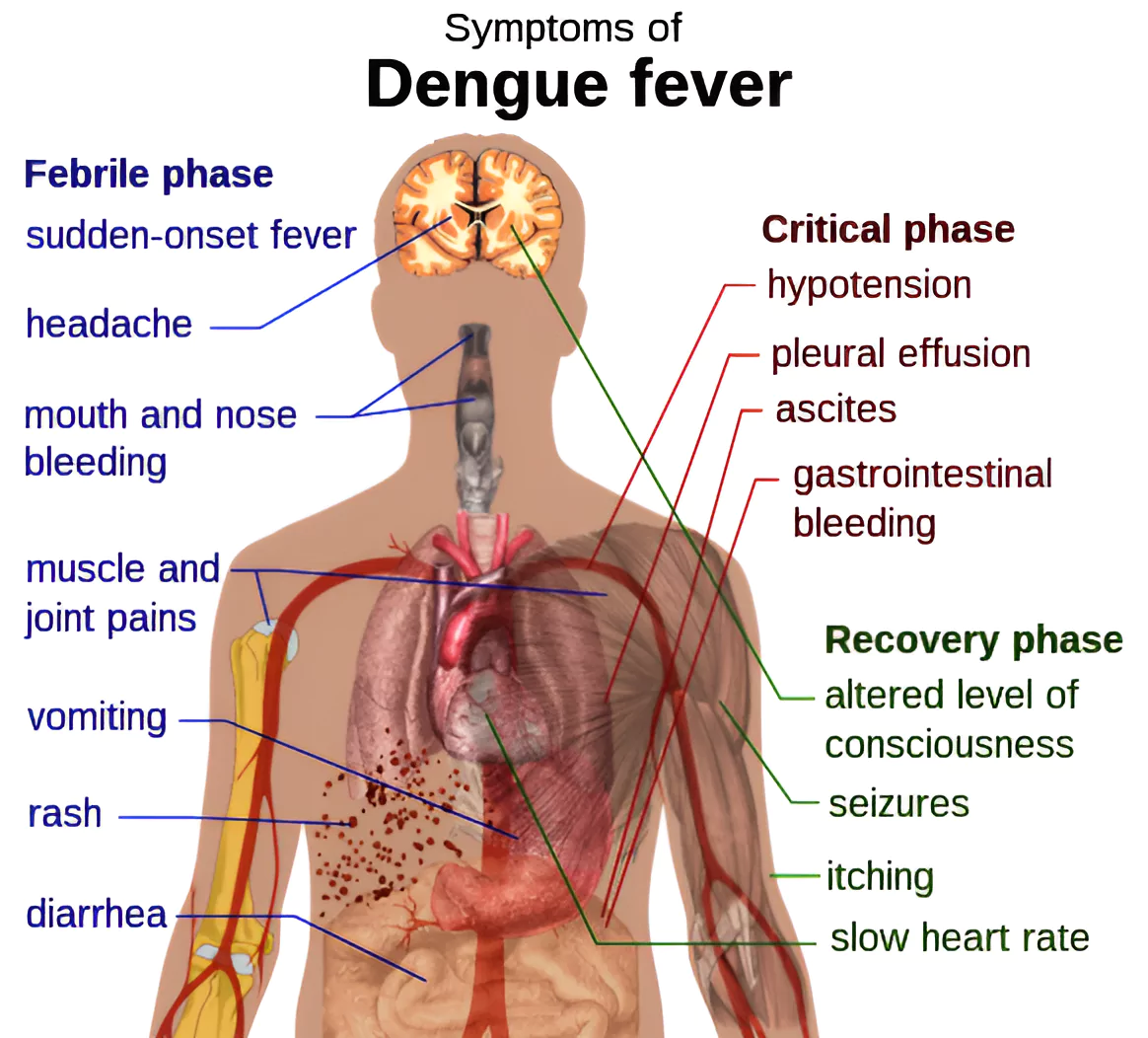 Dengue fever