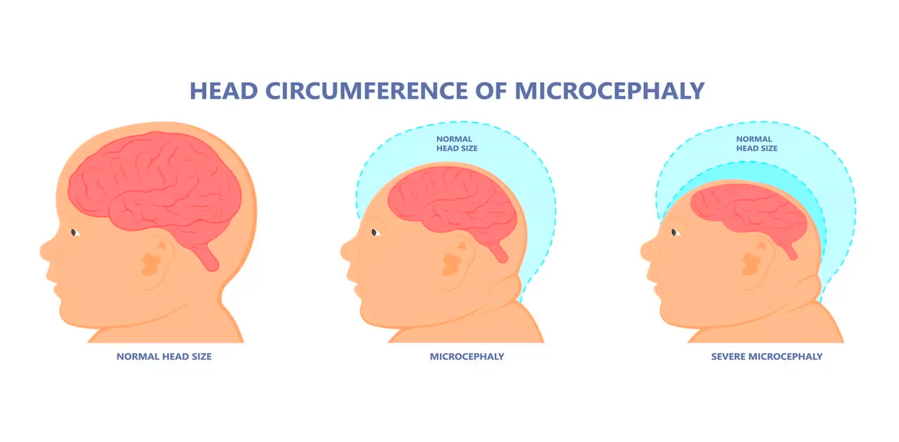 Microcephaly