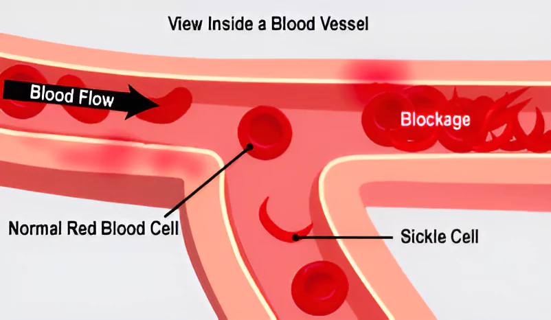 Hydroxyurea in Sickle Cell Disease