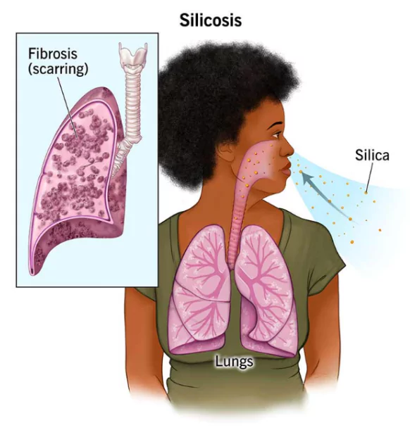 Silicosis