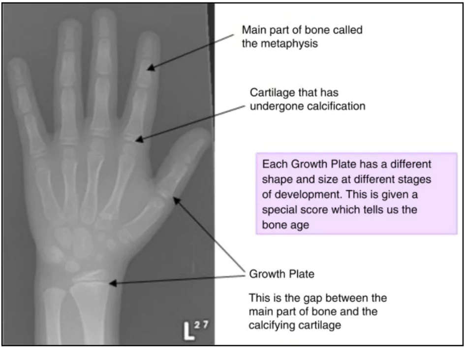 Bone Ossification Test