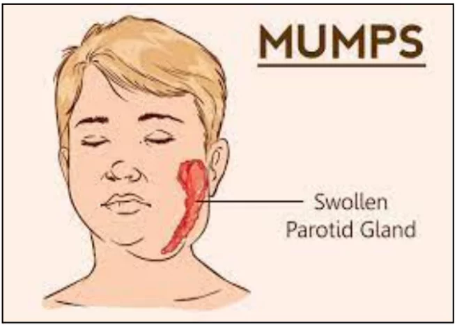 Mumps Vaccine