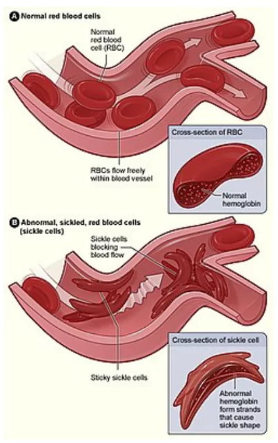 World Sickle Cell Awareness Day