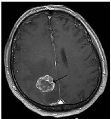 World Brain Tumour Day