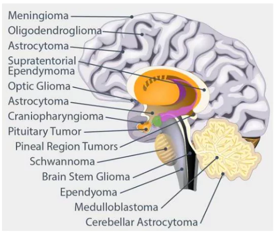 World Brain Tumour Day