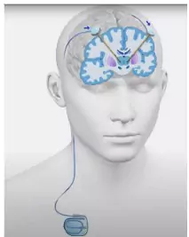 Deep-Brain Stimulation