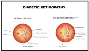Diabetic Retinopathy